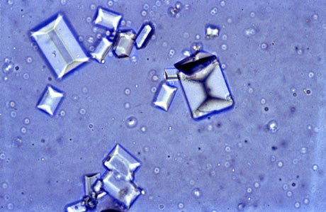 Crystals in the Urine?